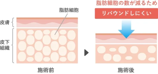 脂肪細胞を除去するためほぼリバウンドしない